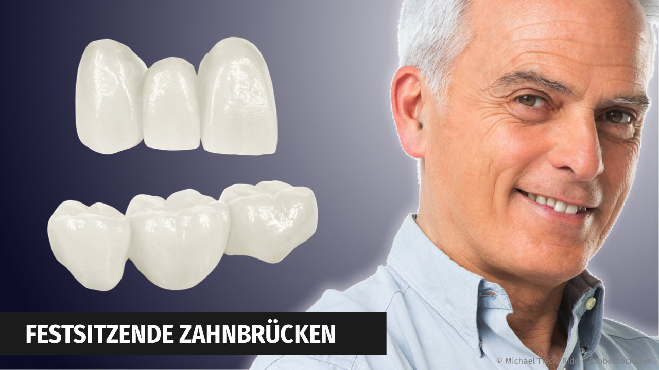 Zahnbrücken aus Keramik mit CEREC